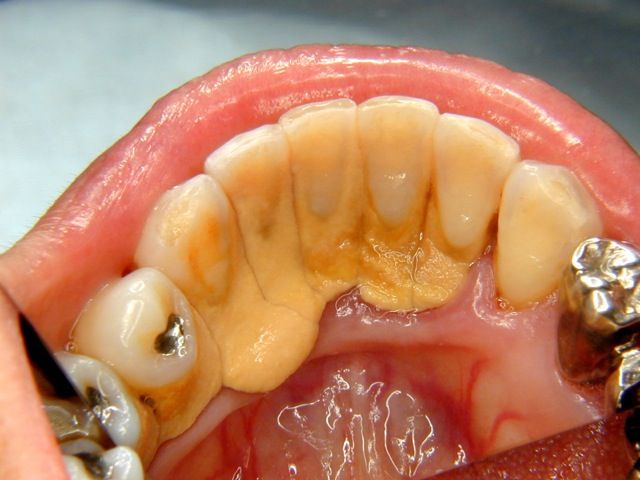 前歯の裏についた歯石（写真）