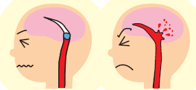 血管が詰まる脳梗塞と血管が破れる脳出血（右）の画像